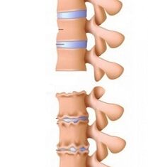 Stopnje rampe osteohondroze vratu