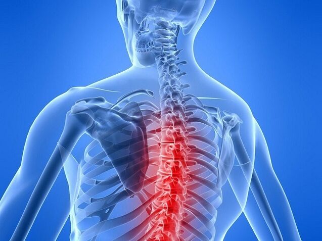 osteohondroza torakalne hrbtenice