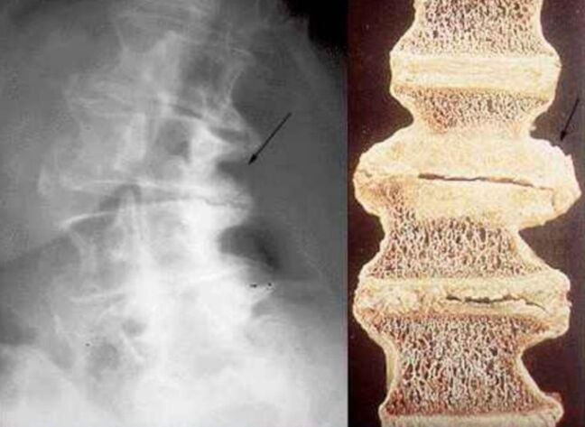 poškodbe vretenc pri torakalni osteohondrozi