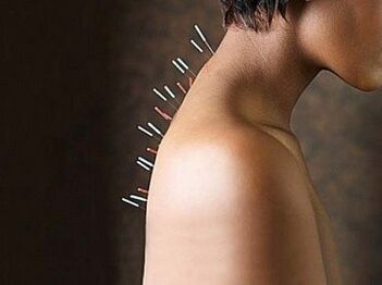 Refleksoterapija je učinkovita metoda zdravljenja cervikalne osteohondroze