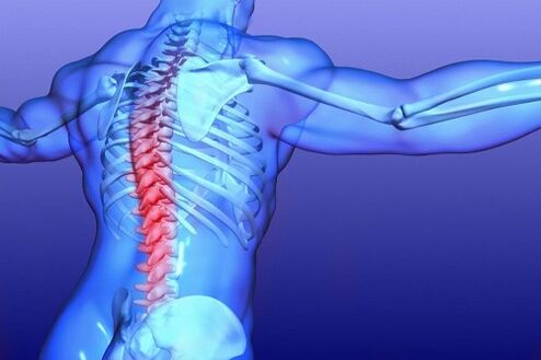 osteohondroza ledvene hrbtenice